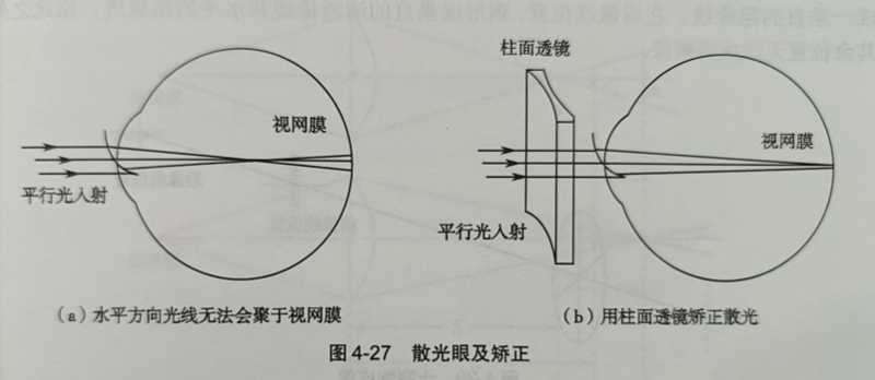 什么是散光眼